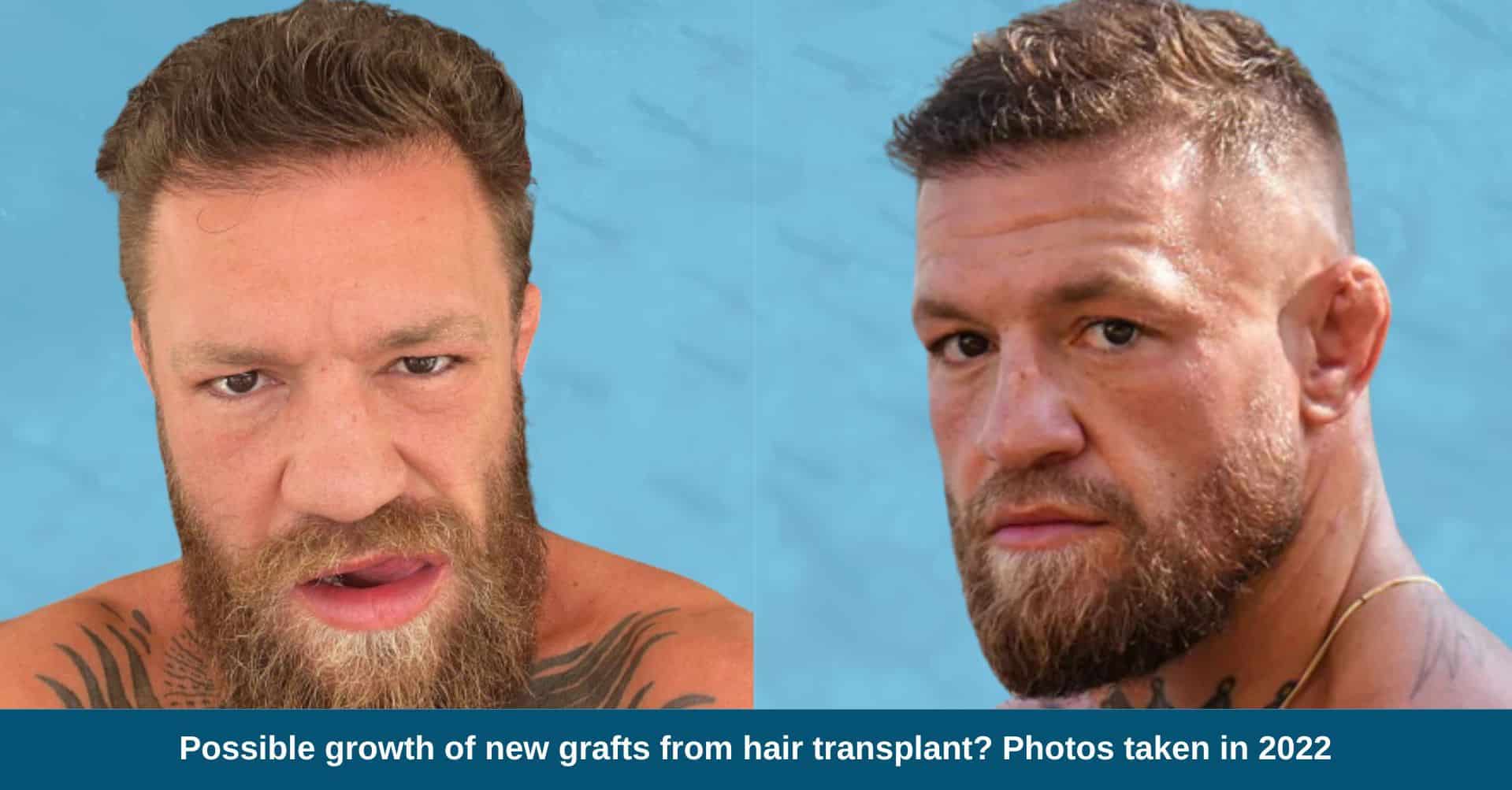 Conor McGregor Balding: Did the UFC Star Undergo a Hair Transplant?