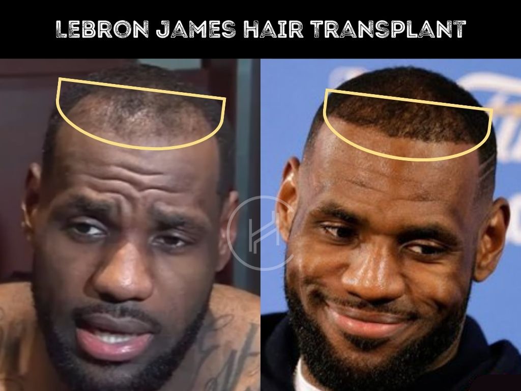LeBron James Hair Before and After: His Transformation Revealed