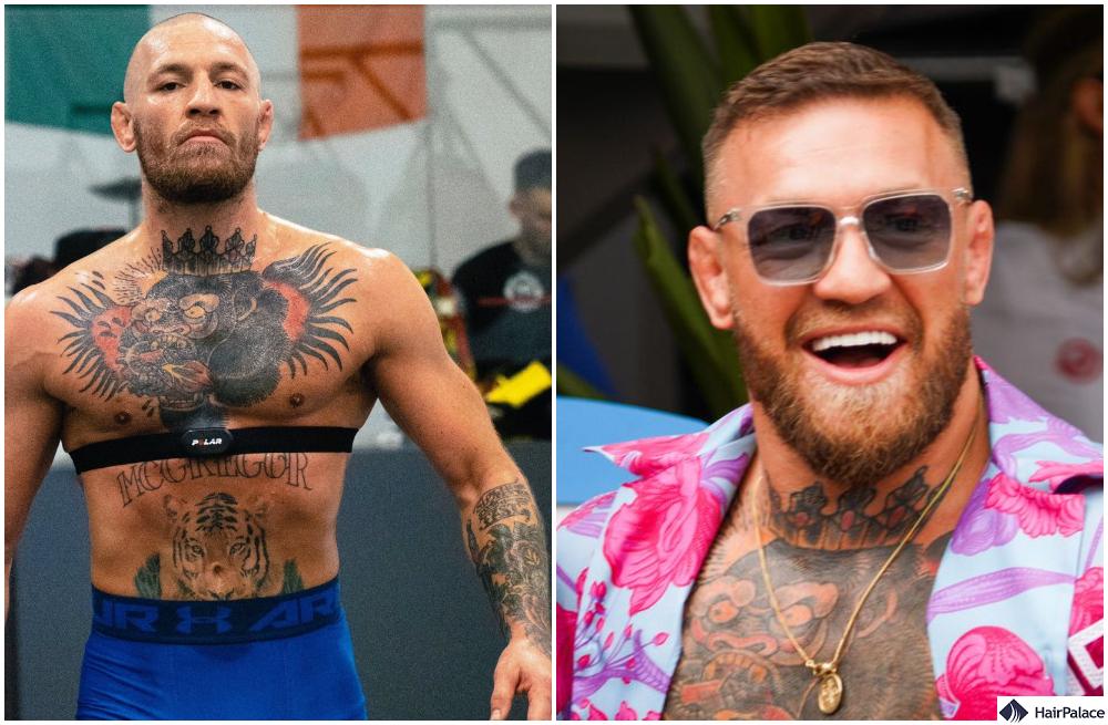 Conor McGregor Balding: Did the UFC Star Undergo a Hair Transplant?