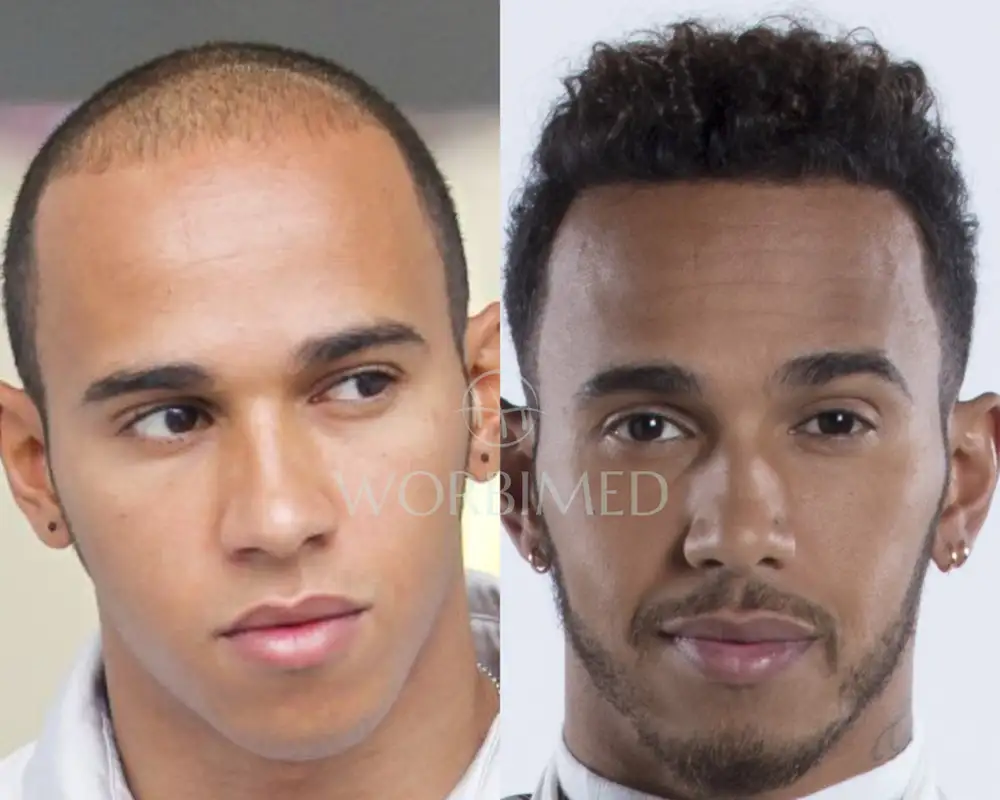 Exploring Lewis Hamiltons Hair Journey: Natural Care or Hair Replacement?