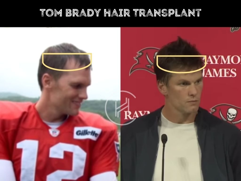 Tom Bradys Hair: Has He Had Hair Implants or a Natural Restoration?