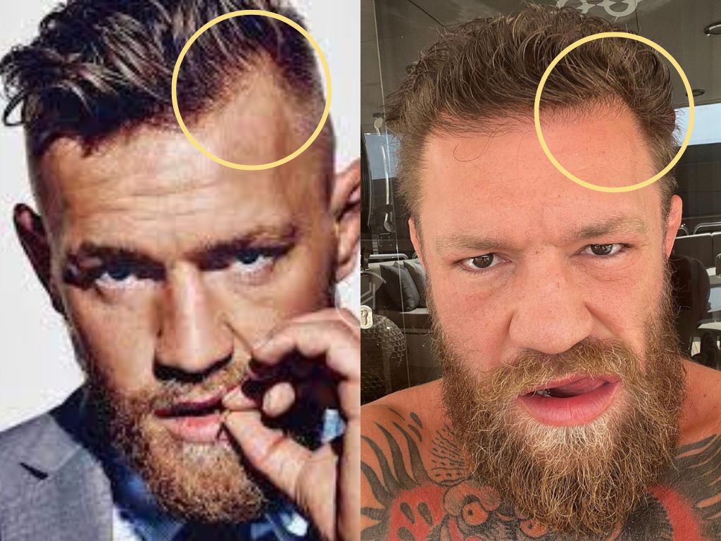 Conor McGregor Balding: Did the UFC Star Undergo a Hair Transplant?