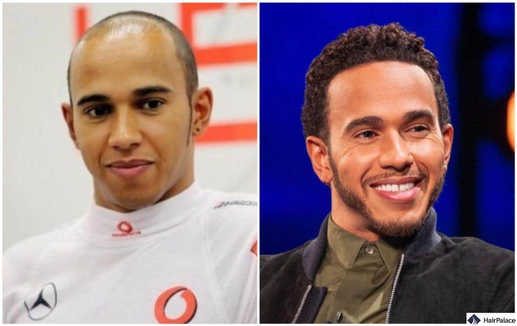 Did Lewis Hamilton Undergo a Hair Transplant? The Truth Behind His Hair Transformation