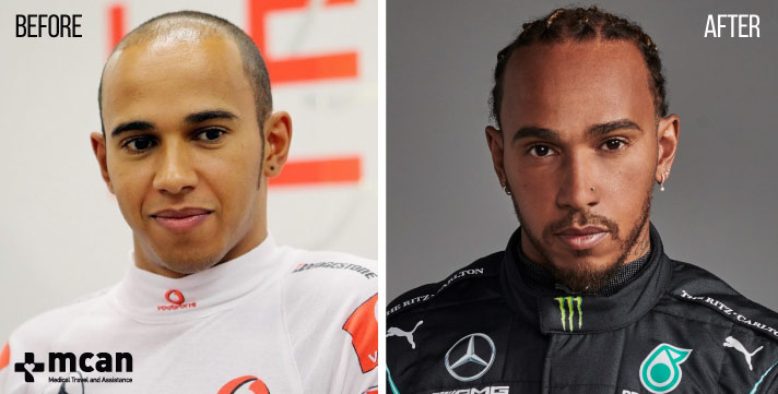 Lewis Hamiltons Bald Look: From Hair Loss to Stylish Shave