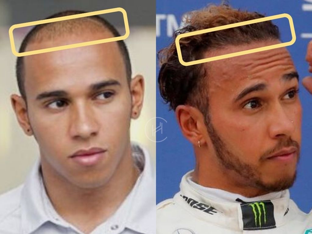 Lewis Hamiltons Bald Look: From Hair Loss to Stylish Shave