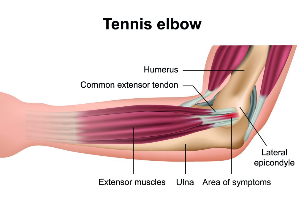 From Elbow to Shoulder: How Tennis Elbow Pain Spreads