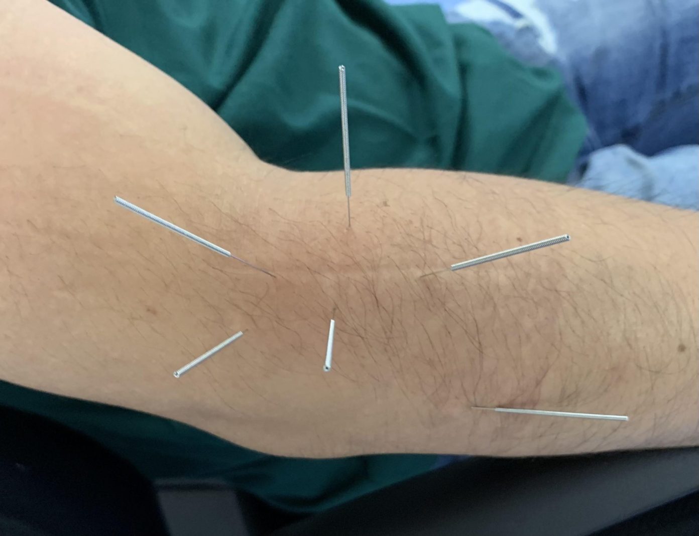 Quick Guide: How Acupuncture Can Help Ease Tennis Elbow Pain