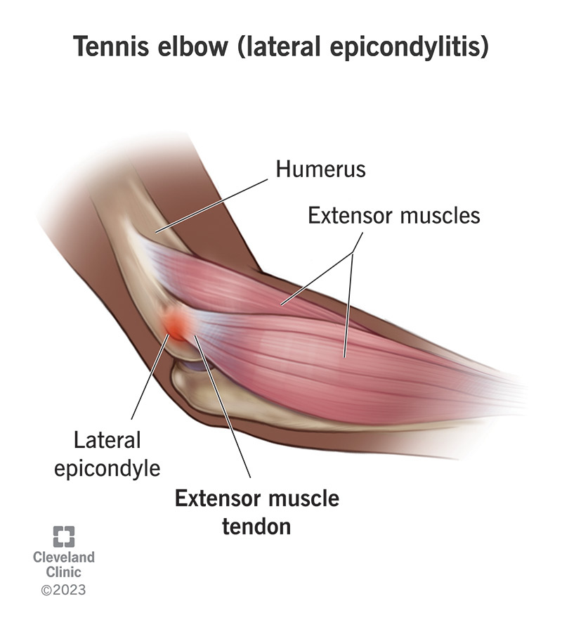 From Elbow to Shoulder: How Tennis Elbow Pain Spreads