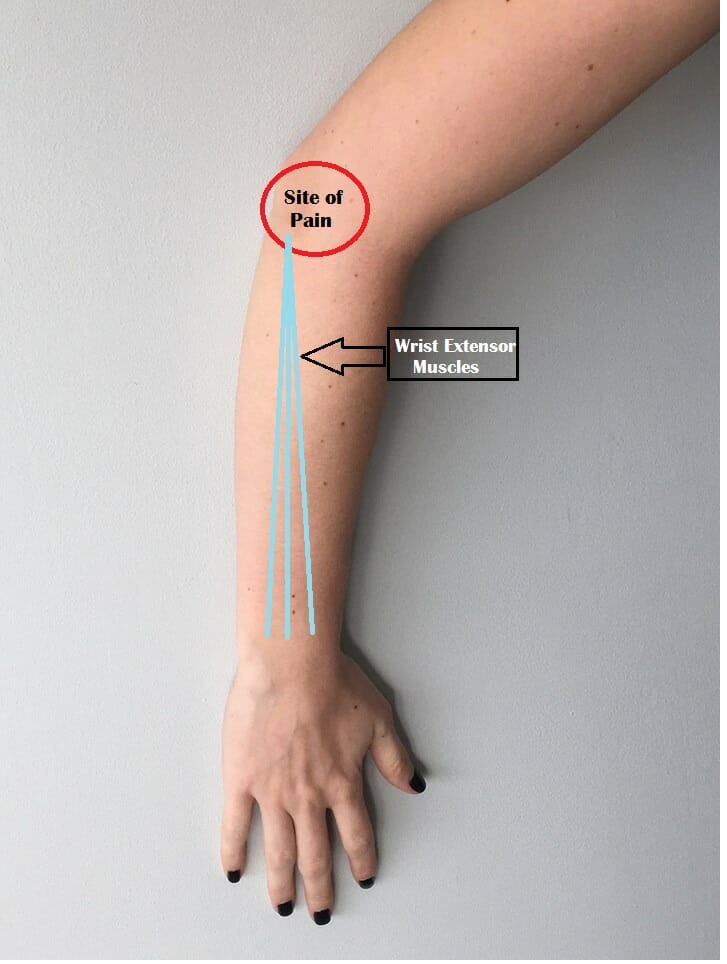 Quick Guide: How Acupuncture Can Help Ease Tennis Elbow Pain