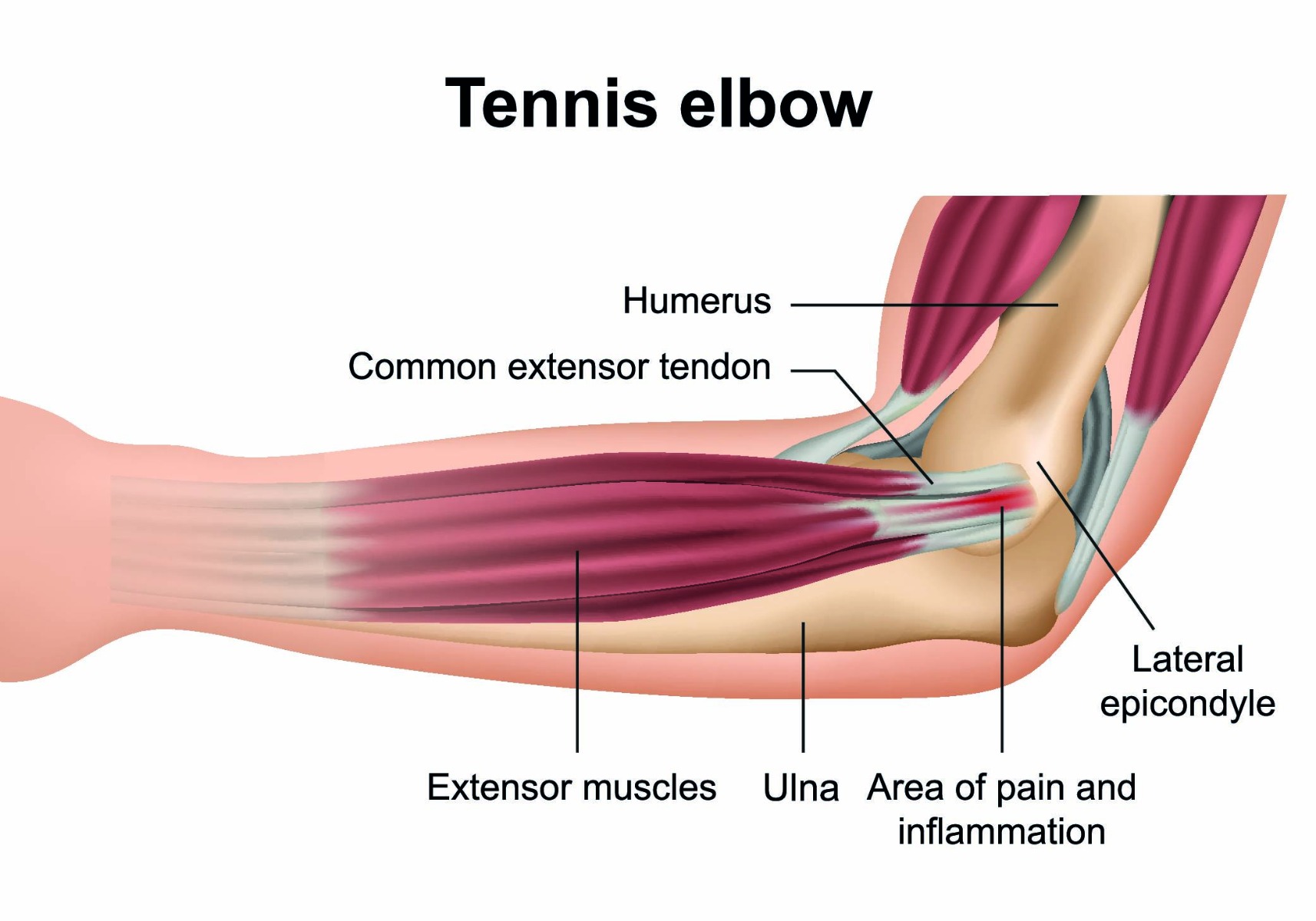 Got Tennis Elbow Pain at Night? Try These Simple Tips!